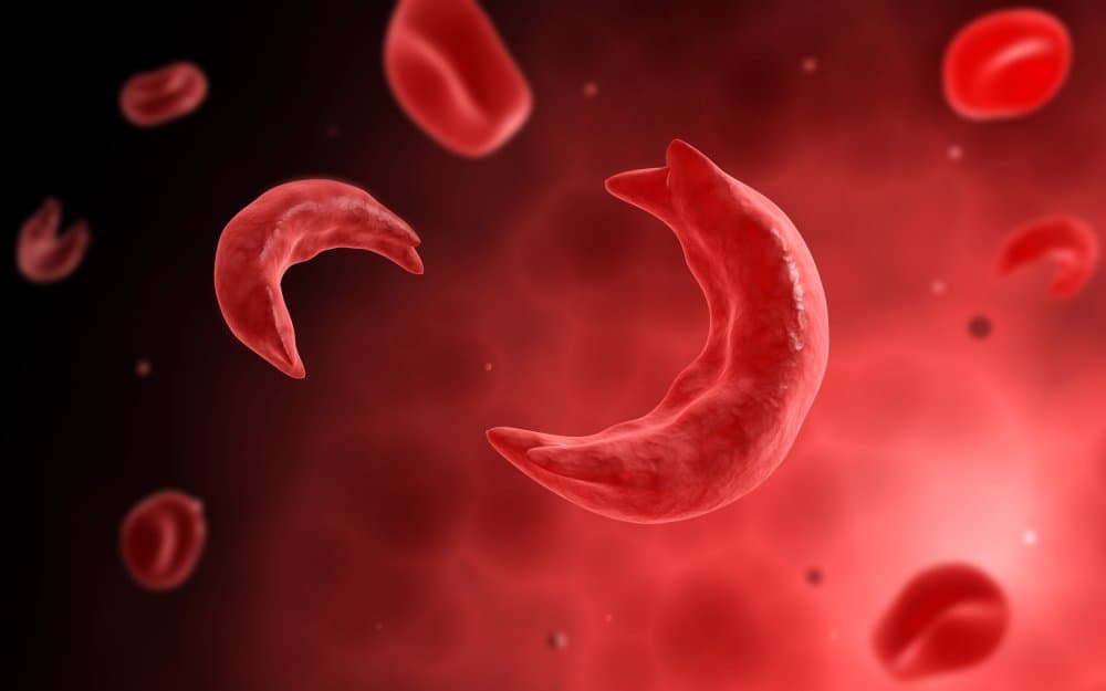 Globule rouge déformé, drépanocytose.